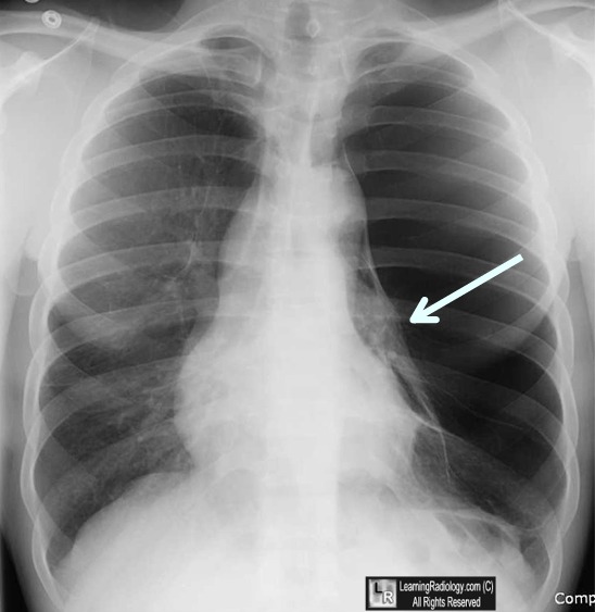 vanishing lung syndrome